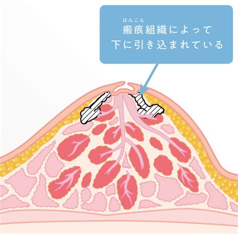 仮性陥没乳首|【助産師監修】陥没乳頭とは？ 原因と種類、問題点と治療法｜ 